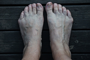 When the Outside of the Foot Becomes a Problem