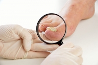 Risk Factors and Treatments for Toenail Infections