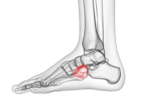 Causes of Cuboid Syndrome