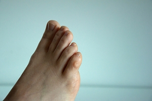 What to Do About Corns on the Feet