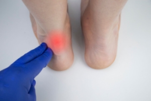 Causes of Achilles Tendonitis