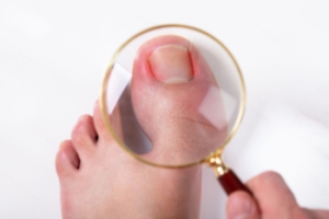 Understanding Ingrown Toenails and Finding Relief