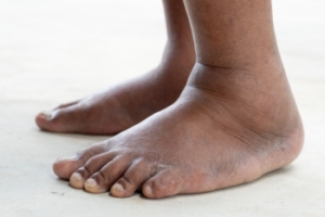 The Difference Between Normal Baby Fat and Swollen Feet