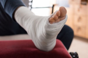 Healing Stages and Expected Recovery Time for a Broken Foot