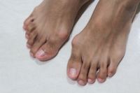 Causes, Symptoms, and Treatment of Bunions