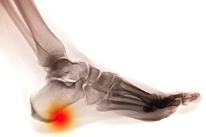 Stretches May Help Heel Spurs