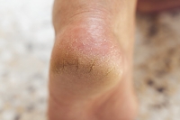 Risks Posed by Cracked Heels